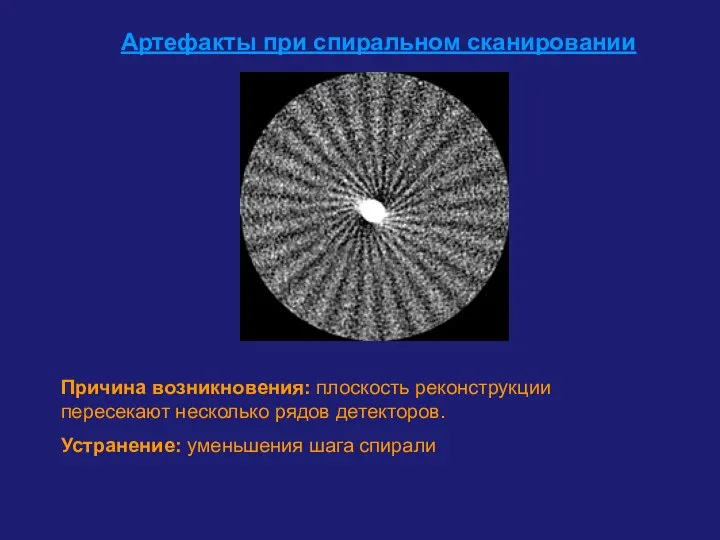 Артефакты при спиральном сканировании Причина возникновения: плоскость реконструкции пересекают несколько рядов детекторов. Устранение: уменьшения шага спирали