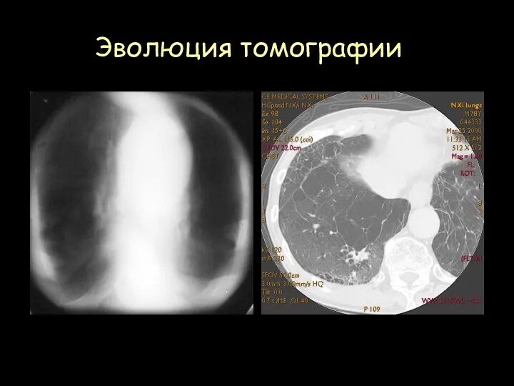 Эволюция томографии Рентгеновская продольная томография легких Компьютерная томография легких