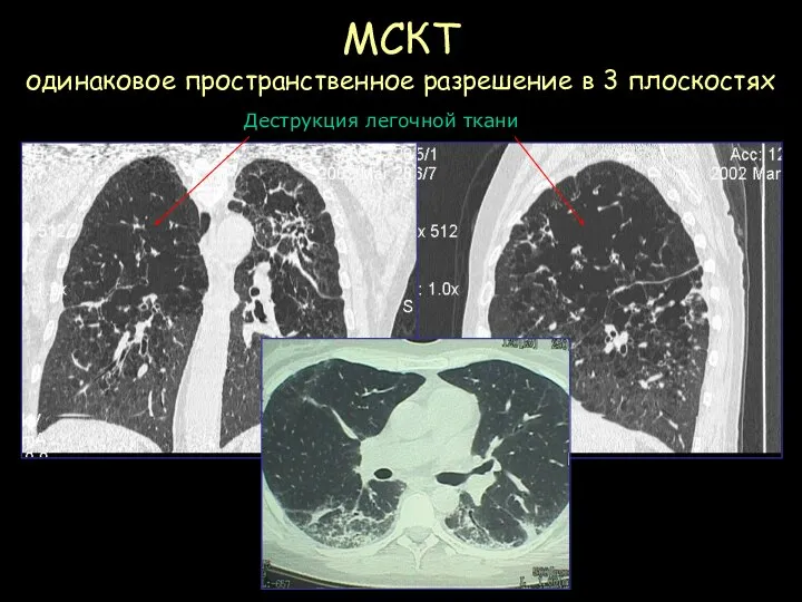 МСКТ одинаковое пространственное разрешение в 3 плоскостях Деструкция легочной ткани