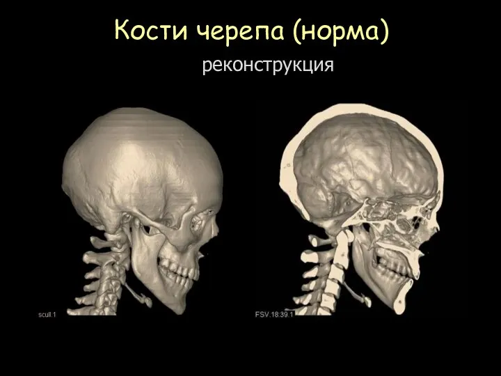 Кости черепа (норма) 3D реконструкция