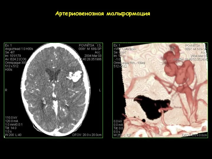 Артериовенозная мальформация