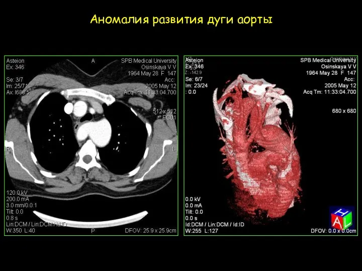 Аномалия развития дуги аорты