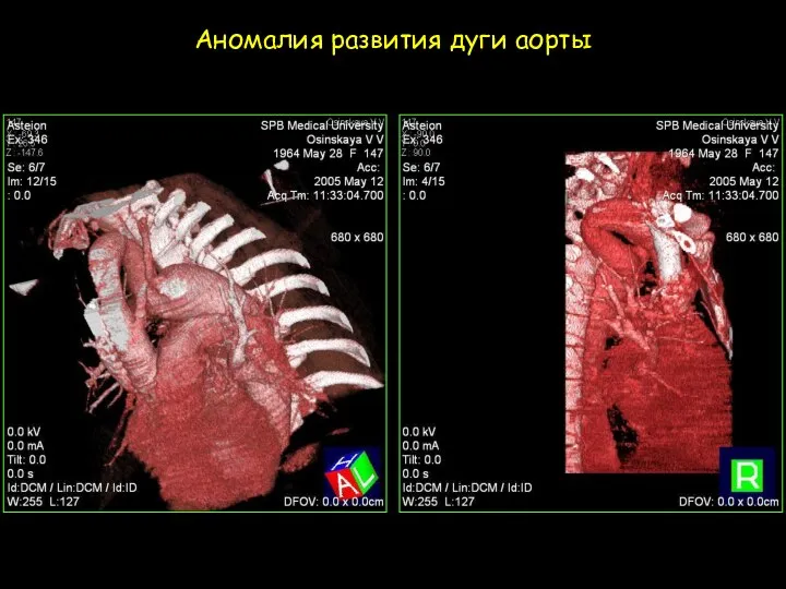 Аномалия развития дуги аорты