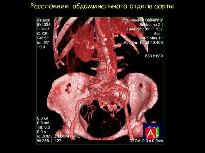 Расслоение абдоминального отдела аорты