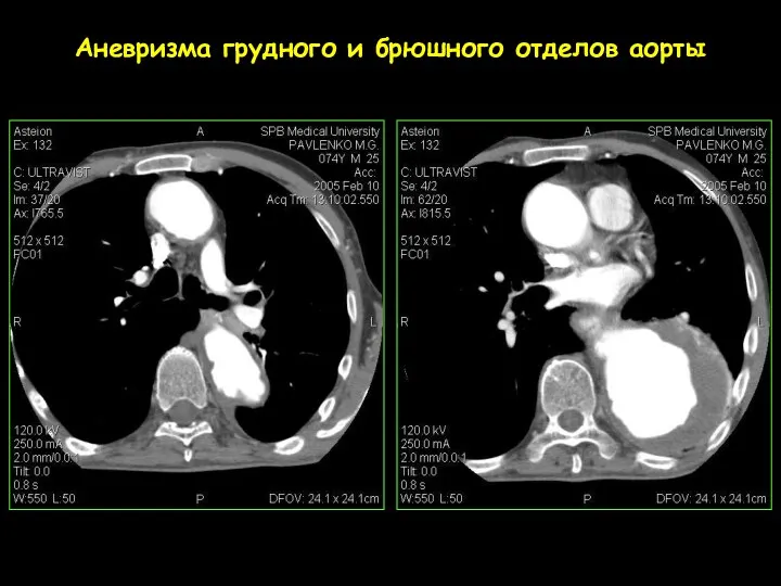 Аневризма грудного и брюшного отделов аорты