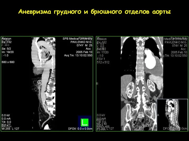 Аневризма грудного и брюшного отделов аорты