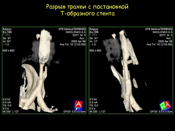 Разрыв трахеи с постановкой Т-образного стента