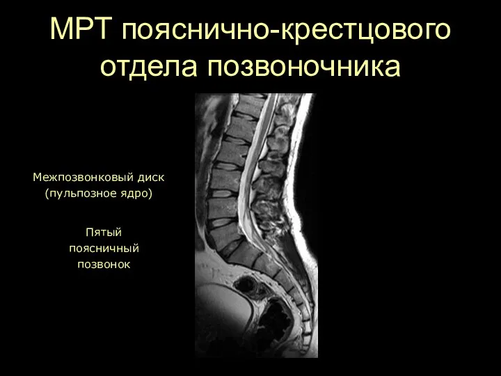 МРТ пояснично-крестцового отдела позвоночника Крестец Пятый поясничный позвонок Межпозвонковый диск (пульпозное