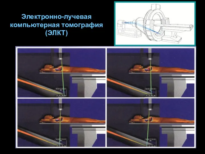 Электронно-лучевая компьютерная томография (ЭЛКТ)