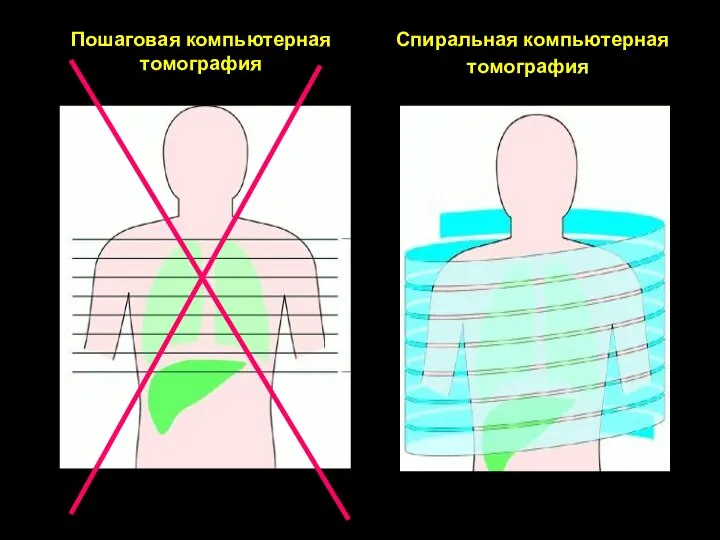 Спиральная компьютерная томография Пошаговая компьютерная томография