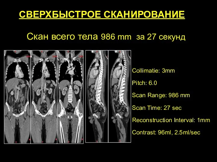 Скан всего тела 986 mm за 27 секунд Collimatie: 3mm Pitch: