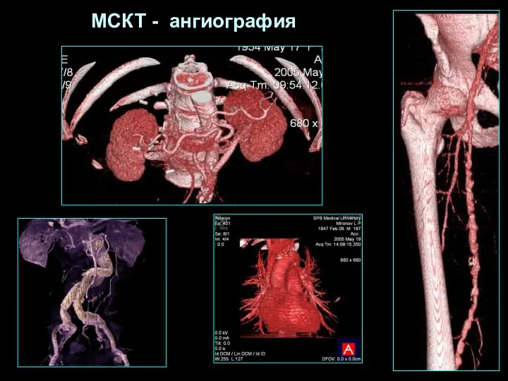 МСКТ - ангиография