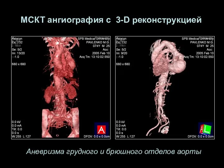 Аневризма грудного и брюшного отделов аорты МСКТ ангиография с 3-D реконструкцией