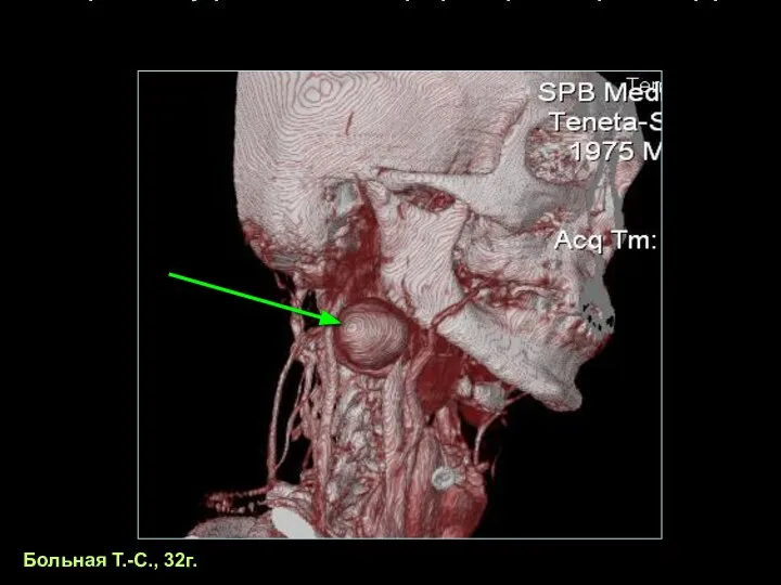 Аневризма внутренней сонной артерии при синдроме Марфана Больная Т.-С., 32г.