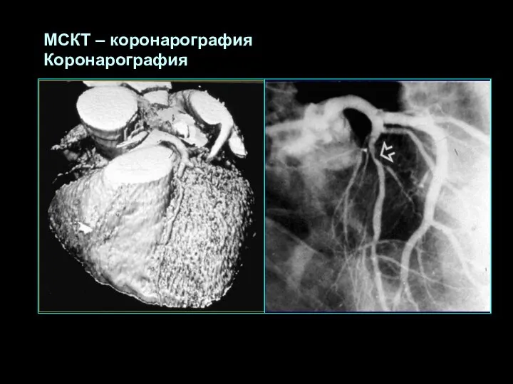 МСКТ – коронарография Коронарография