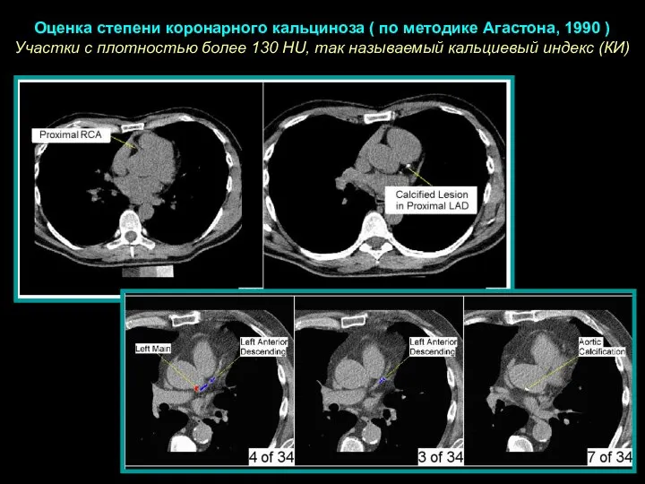 Оценка степени коронарного кальциноза ( по методике Агастона, 1990 ) Участки