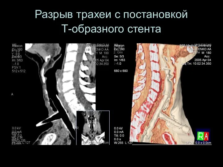 Разрыв трахеи с постановкой Т-образного стента