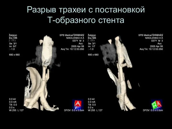 Разрыв трахеи с постановкой Т-образного стента