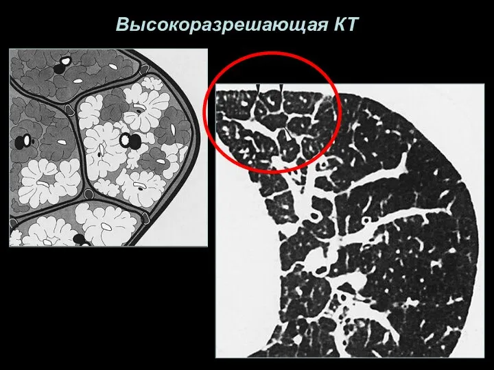 Высокоразрешающая КТ