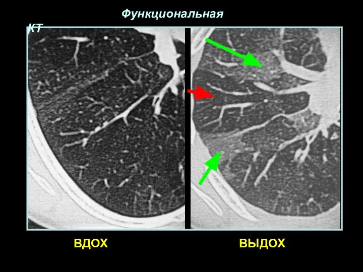 ВДОХ ВЫДОХ Функциональная КТ