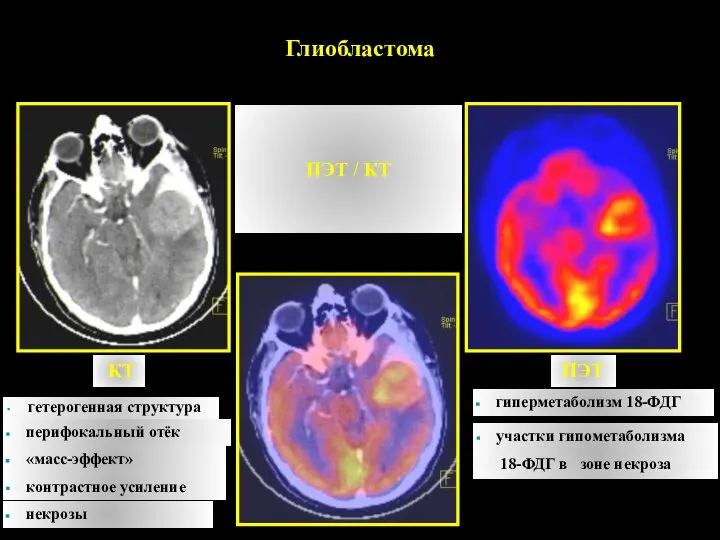 ПЭТ / КТ Глиобластома КТ ПЭТ гетерогенная структура перифокальный отёк «масс-эффект»