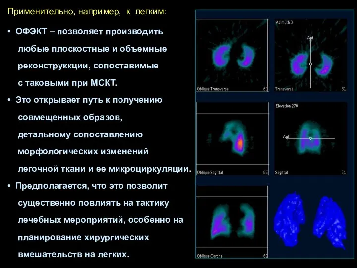 ОФЭКТ – позволяет производить любые плоскостные и объемные реконструккции, сопоставимые с