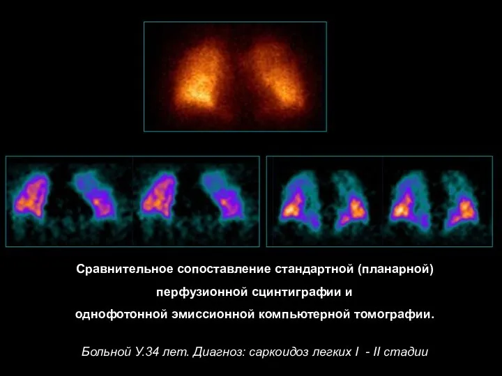 Сравнительное сопоставление стандартной (планарной) перфузионной сцинтиграфии и однофотонной эмиссионной компьютерной томографии.