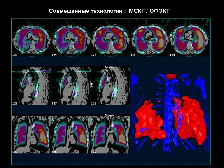 Совмещенные технологии : МСКТ / ОФЭКТ
