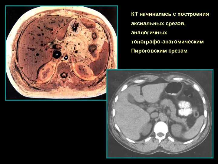 КТ начиналась с построения аксиальных срезов, аналогичных топографо-анатомическим Пироговским срезам