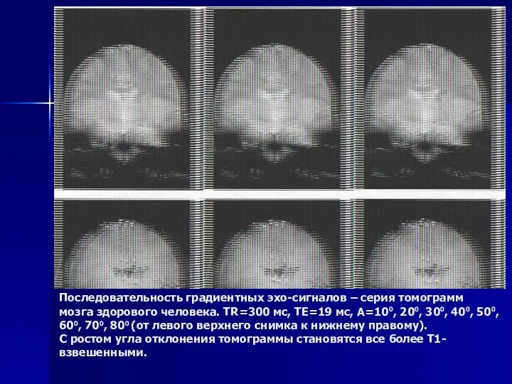 Последовательность градиентных эхо-сигналов – серия томограмм мозга здорового человека. TR=300 мс,