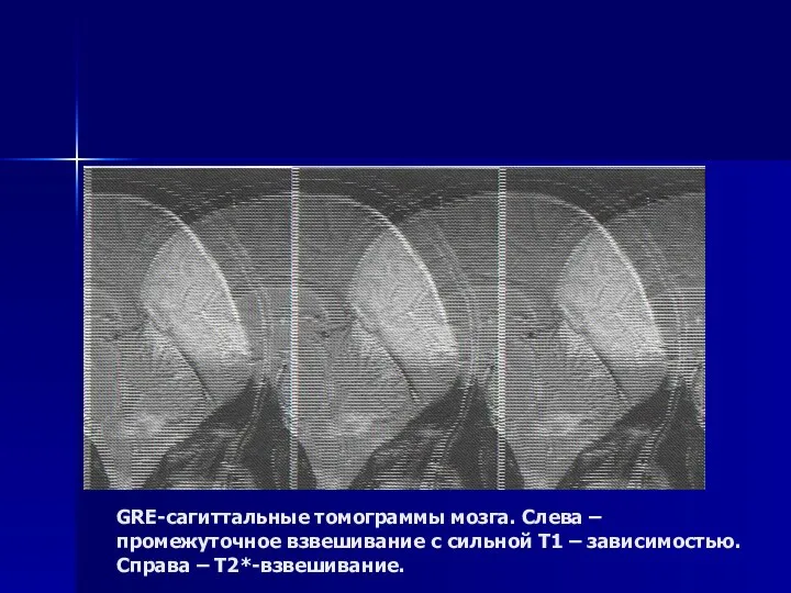 GRE-сагиттальные томограммы мозга. Слева – промежуточное взвешивание с сильной Т1 – зависимостью. Справа – Т2*-взвешивание.