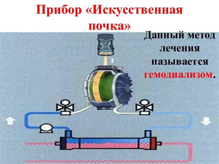 Прибор «Искусственная почка» Данный метод лечения называется гемодиализом.