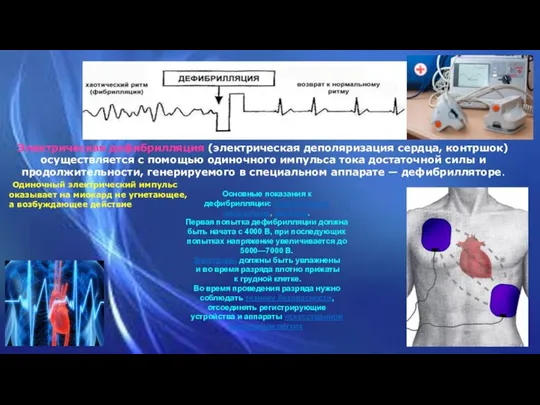 Электрическая дефибрилляция (электрическая деполяризация сердца, контршок) осуществляется с помощью одиночного импульса