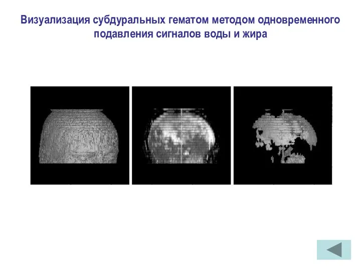 Визуализация субдуральных гематом методом одновременного подавления сигналов воды и жира