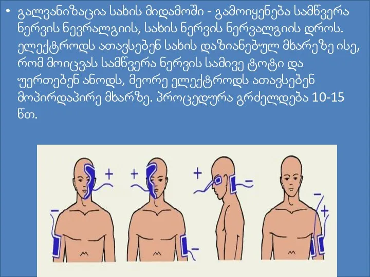 გალვანიზაცია სახის მიდამოში - გამოიყენება სამწვერა ნერვის ნევრალგიის, სახის ნერვის ნერვალგიის