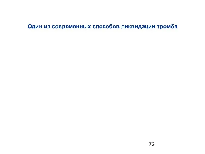 Один из современных способов ликвидации тромба