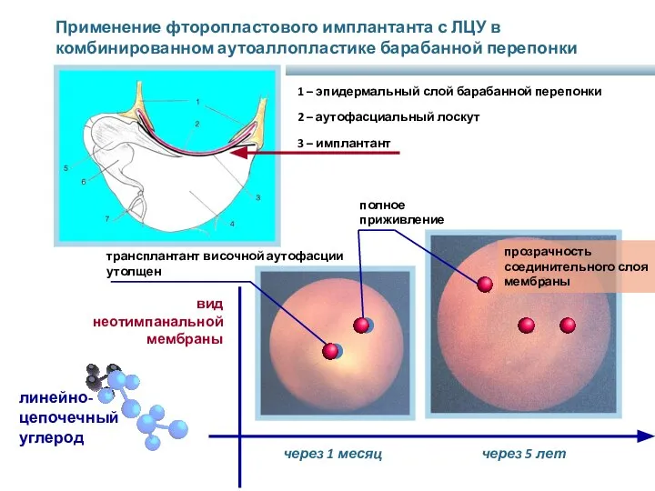 Применение фторопластового имплантанта с ЛЦУ в комбинированном аутоаллопластике барабанной перепонки 1