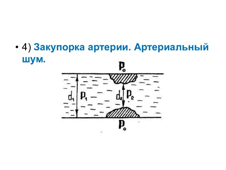 4) Закупорка артерии. Артериальный шум.