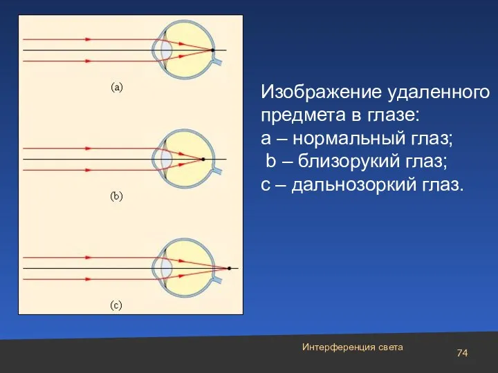 Изображение удаленного предмета в глазе: a – нормальный глаз; b –