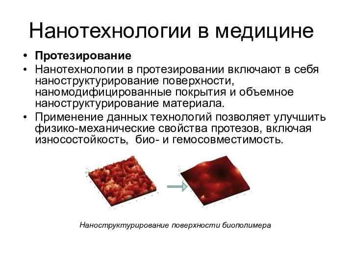 Нанотехнологии в медицине Протезирование Нанотехнологии в протезировании включают в себя наноструктурирование