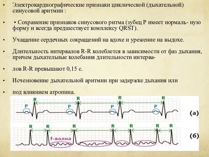 Электрокардиографические признаки циклической (дыхательной) синусовой аритмии : • Сохранение признаков синусового