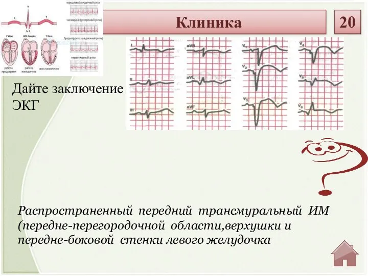 Распространенный передний трансмуральный ИМ (передне-перегородочной области,верхушки и передне-боковой стенки левого желудочка Дайте заключение ЭКГ Клиника 20