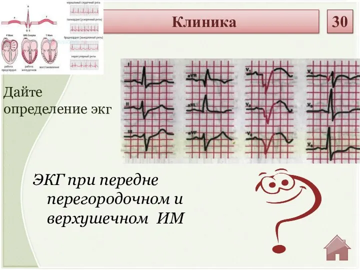 ЭКГ при передне перегородочном и верхушечном ИМ Дайте определение экг Клиника 30