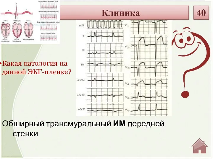 Обширный трансмуральный ИМ передней стенки Какая патология на данной ЭКГ-пленке? Клиника 40