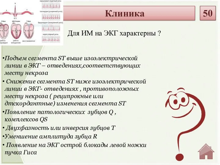 Подъем сегмента ST выше изоэлектрической линии в ЭКГ – отведениях,соответствующих месту