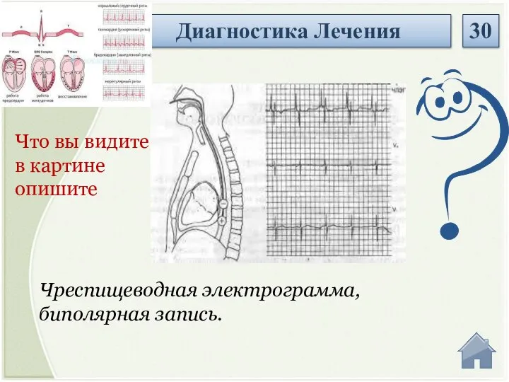 Чреспищеводная электрограмма, биполярная запись. Что вы видите в картине опишите Диагностика Лечения 30