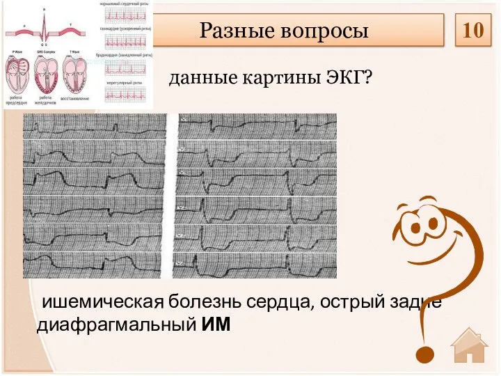 ишемическая болезнь сердца, острый задне диафрагмальный ИМ данные картины ЭКГ? Разные вопросы 10