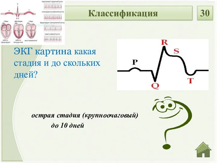 острая стадия (крупноочаговый) до 10 дней ЭКГ картина какая стадия и до скольких дней? Классификация 30