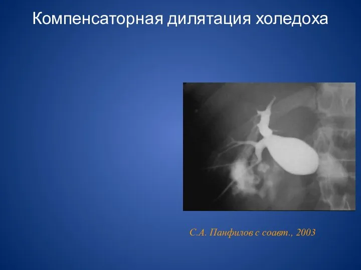 Компенсаторная дилятация холедоха С.А. Панфилов с соавт., 2003