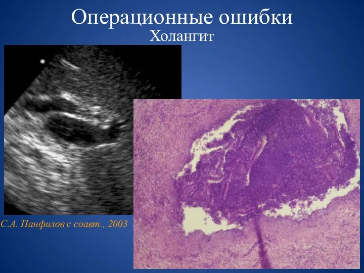 Операционные ошибки Холангит С.А. Панфилов с соавт., 2003